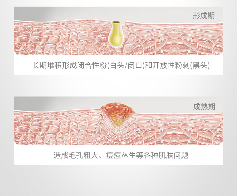 童兮黑竹炭净肤蛋蛋面纱霜去黑头粉刺角质T区护理鼻膜撕拉面膜详情5