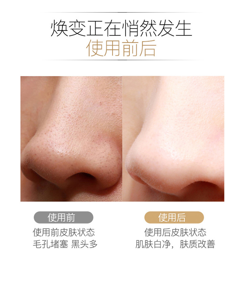 超声波铲皮机面部清洁仪毛孔清洁器脸部洁面仪黑头仪器黑头铲详情32