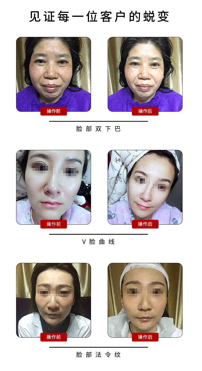 跨境电商新款雷达V雕雷达线雕家用嫩肤仪面部RF射频仪手持导入仪详情10