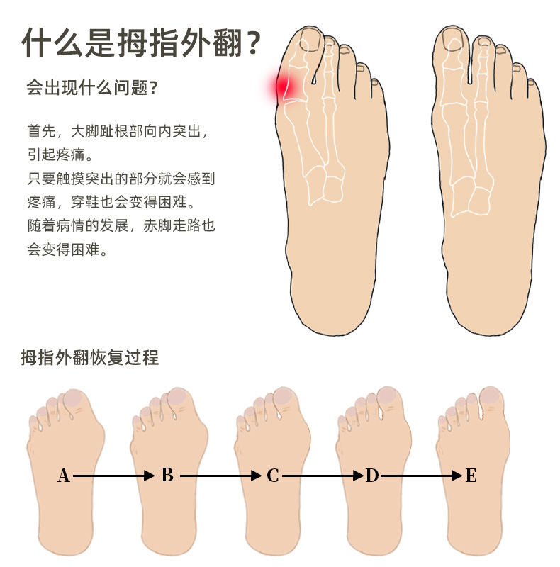 Cross-border bestseller: Five-hole toe separation correction set for hallux valgus, a unisex toe orthopedic wonder, a toe separator pic 3