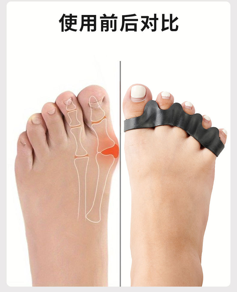 Five-hole toe separator for hallux valgus, big toe bone overlap, toe clamp, orthosis, toe separator pad, adjustable separator pic 5