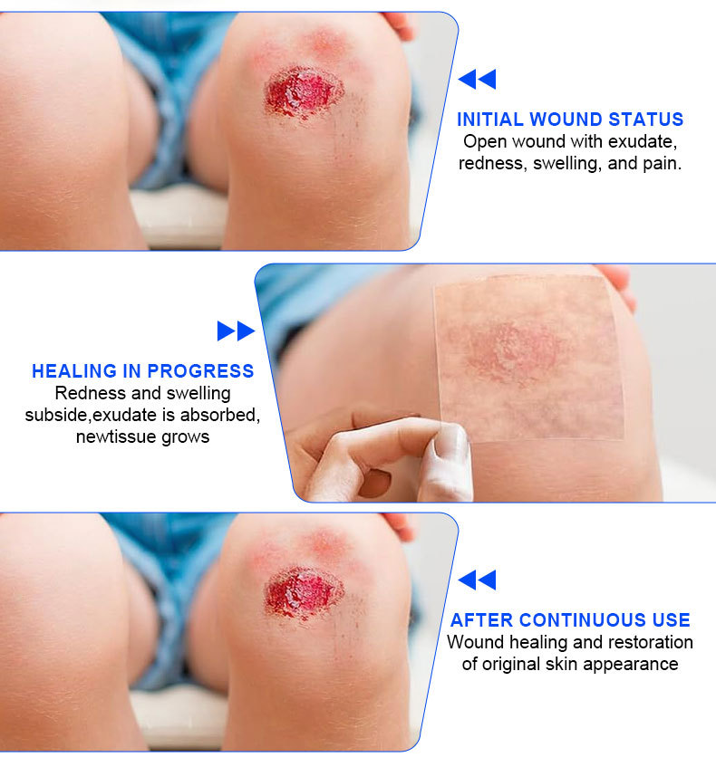 Amazon hydrocolloid roll wound dressing has strong water absorption. It is a hydrocolloid dressing for wet healing of superficial burns with liquid absorption pic 3