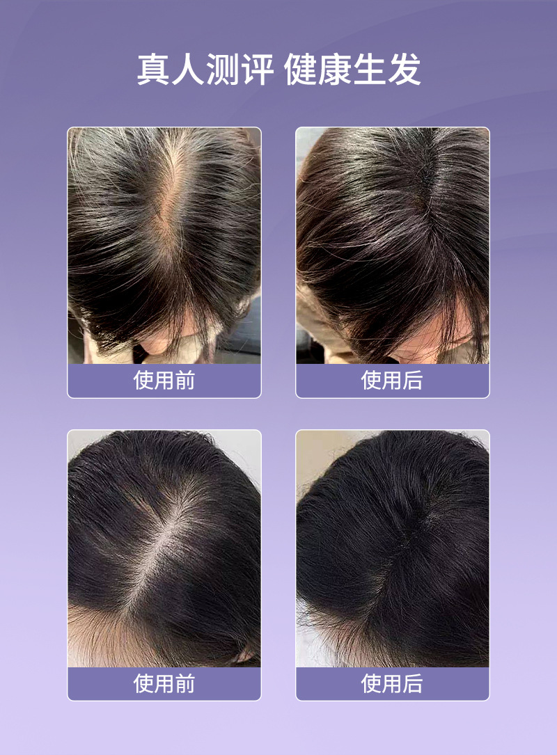 电动按摩梳红光上药梳头部给药育发精油振动滚珠头疗导液梳详情3