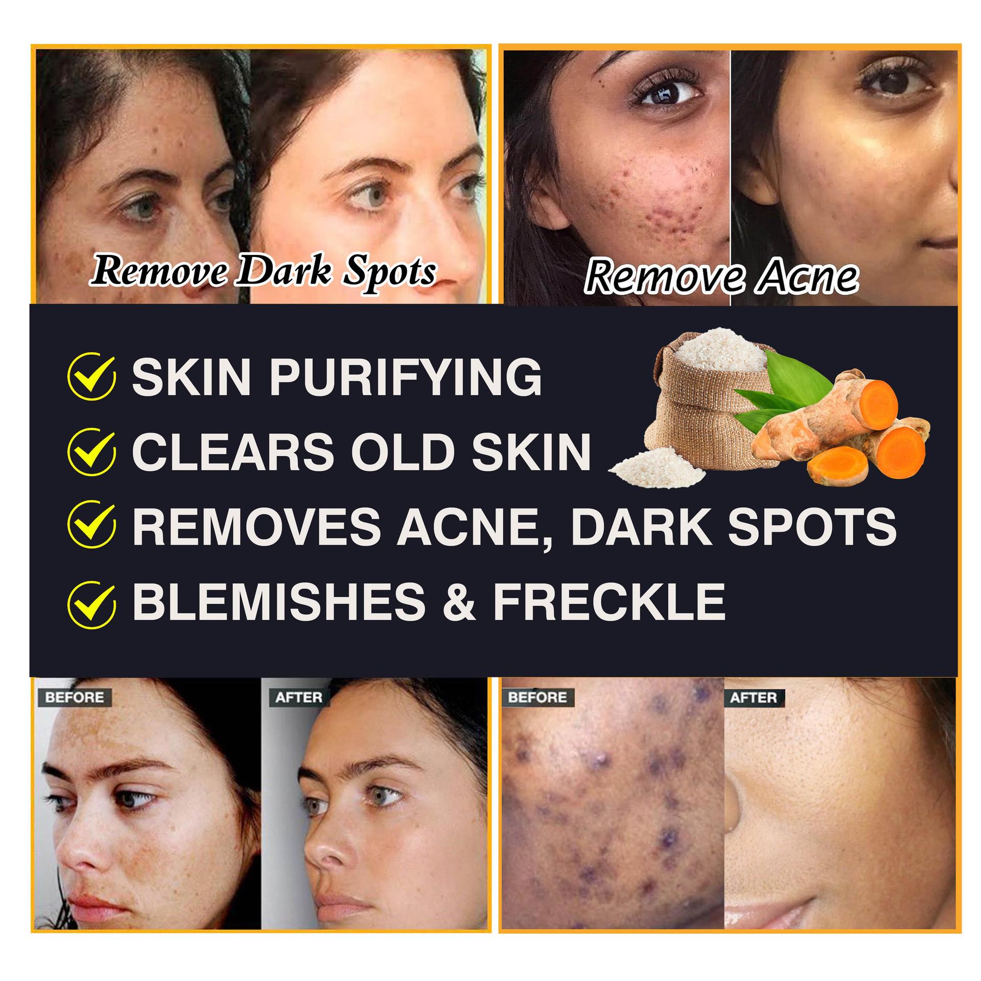 DV-6622Removes Acne, Dark Spot