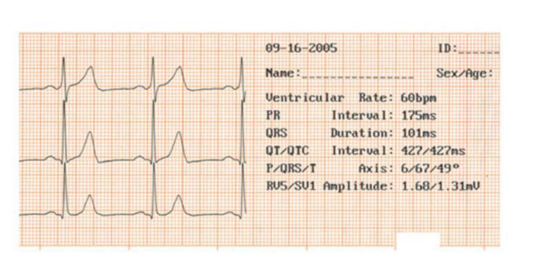 跨境专供ECG32A心电图机医用便携式欧插12导3通道数字心电图机详情9