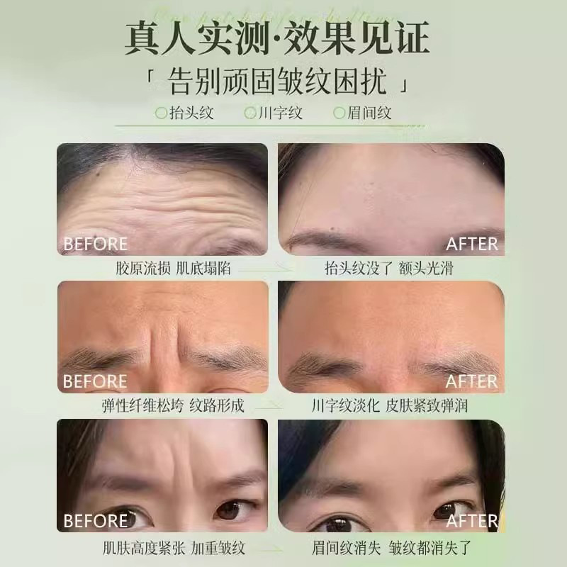 Microcurrent forehead beauty patch Lifting and firming face care device, reducing forehead wrinkles and frown lines, facial care beauty device pic 6