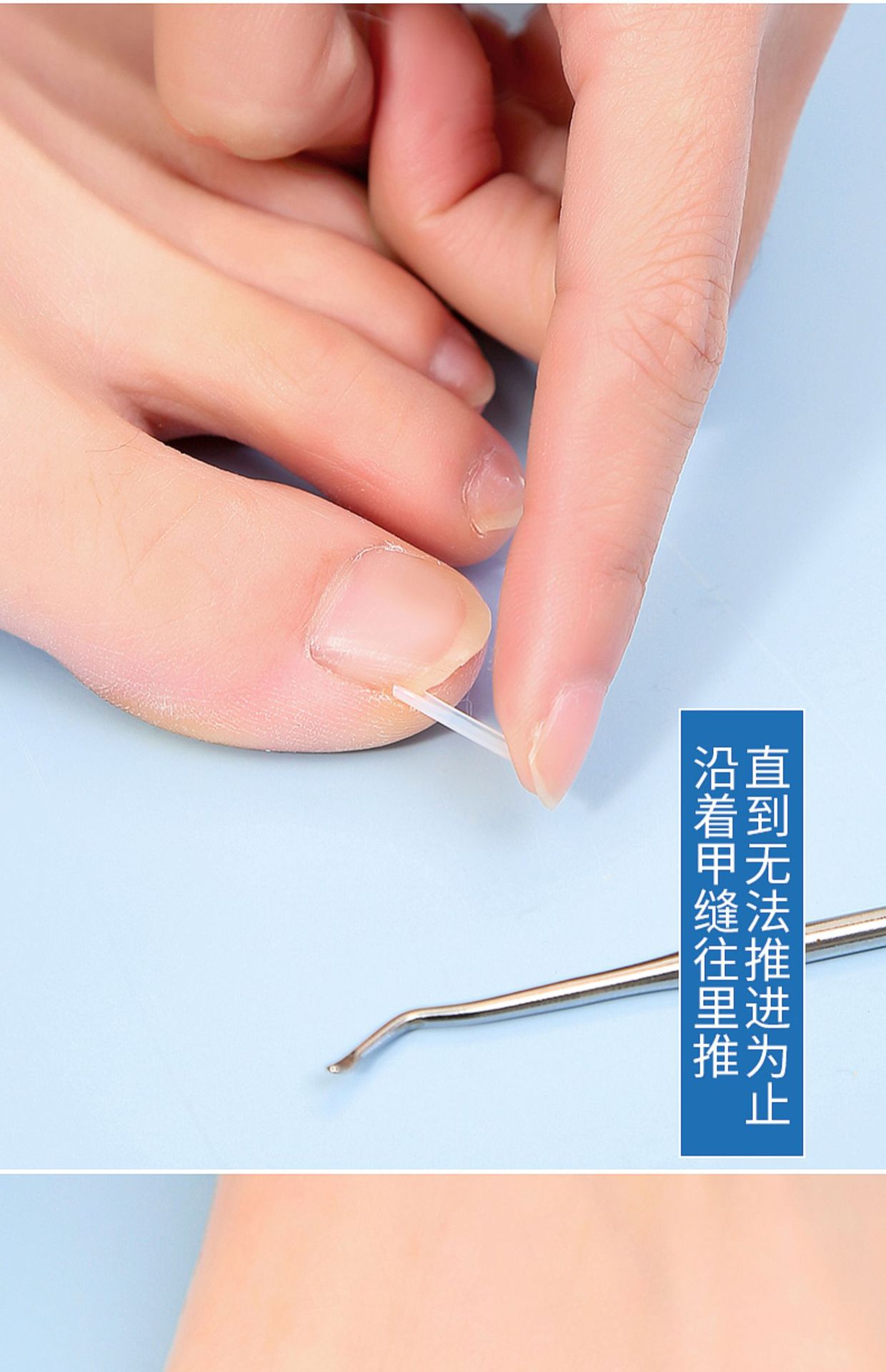 Nail groove corrector, a must-have tool for inflammation, nail straightening patch, nail patch, ingrown toenail, toenail growing into the flesh correction, filling and gasket pic 5