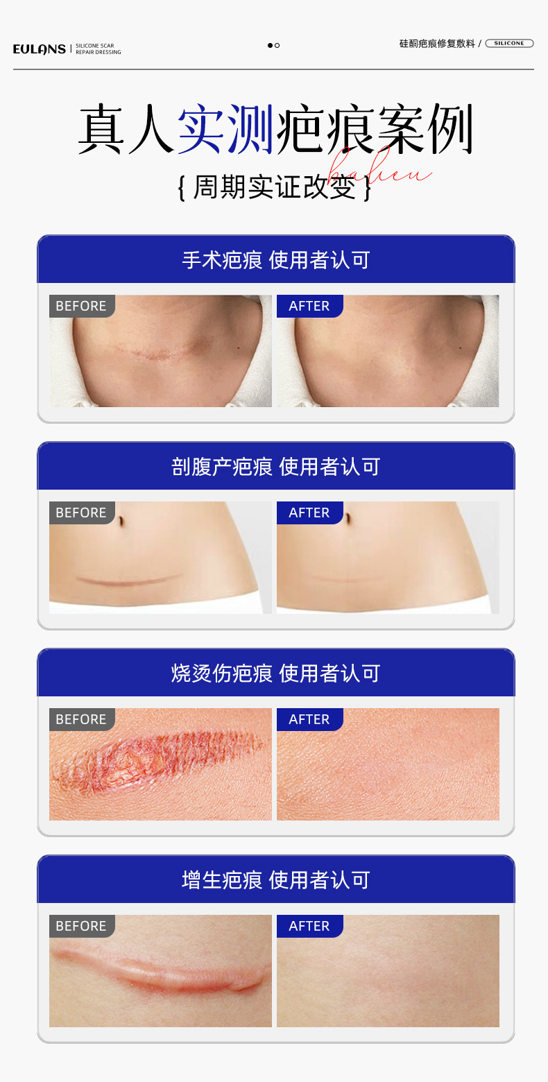 二类医疗器械疤痕膏淡化痘印烧烫伤剖腹产疤痕术后皮肤护理批发详情6