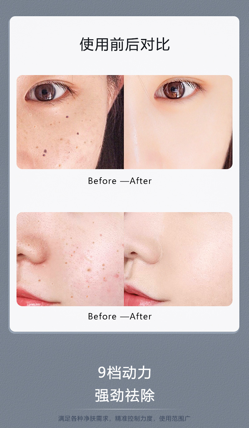 小白点痣笔扫斑机9档蓝光修护家用激光去痣仪器美容院用批发详情7