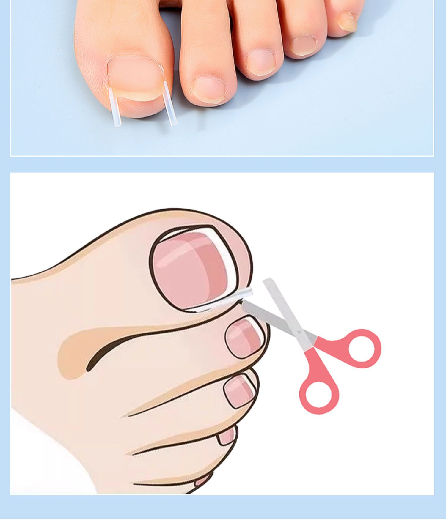 Nail groove corrector, a must-have tool for inflammation, nail straightening patch, nail patch, ingrown toenail, toenail growing into the flesh correction, filling and gasket pic 7