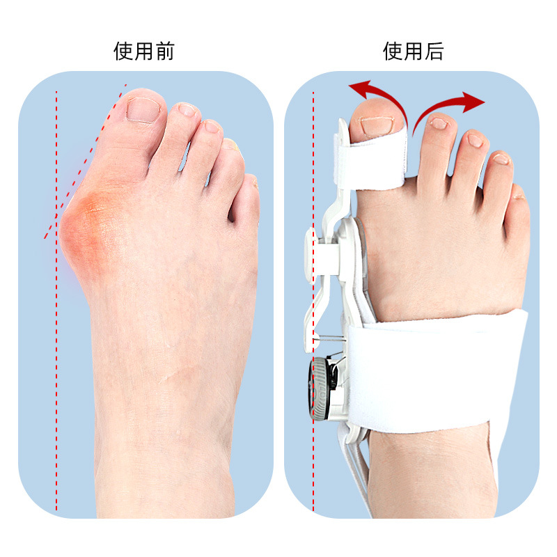 Thumb eversion orthosis, big foot bone protrusion overlapping toe separator, day and night adjustable knob orthosis Application Scenario