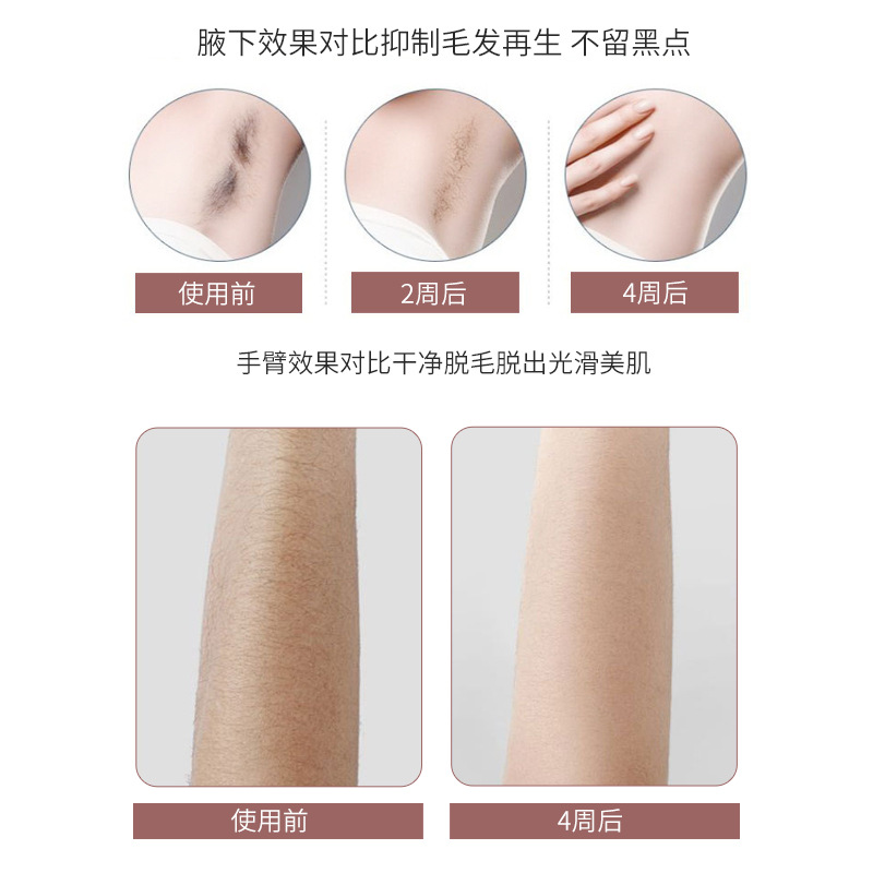 shanilak home full-body hair removal device, ice-sensing strong pulse light therapy device, ice point hair removal device Application Scenario