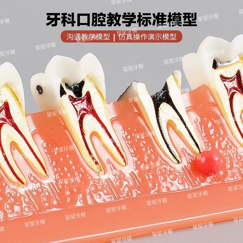Dental caries model M4011: The development of caries and secondary caries medical teaching model in dentistry Specification image