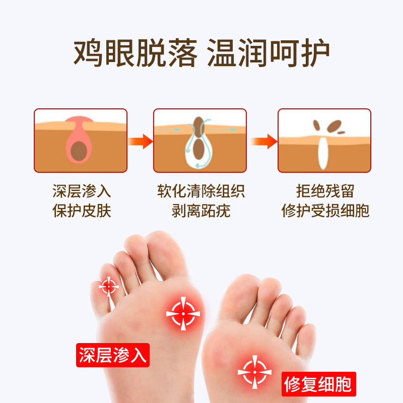 Chicken Eye Patches And Chicken Eye Ointment Patches Can Remove Hard Calluses, Old Calluses, Hand And Foot Calluses, And Provide A Comfortable Foot Pad. Customized From The Original Manufacturer details Picture