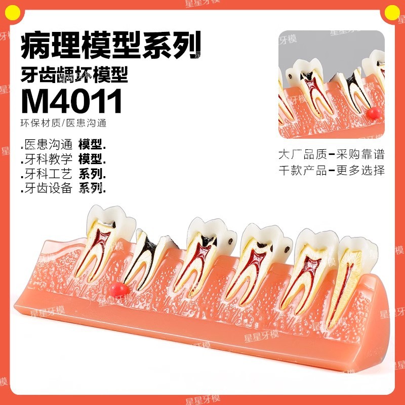 Dental caries model M4011: The development of caries and secondary caries medical teaching model in dentistry