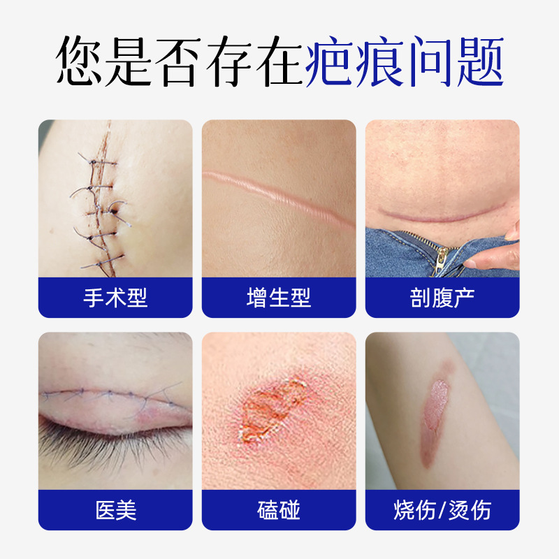 二类医疗器械疤痕膏淡化痘印烧烫伤剖腹产疤痕术后皮肤护理批发产品图