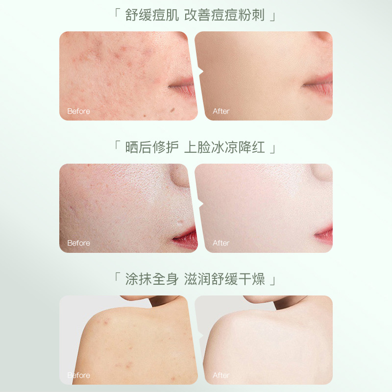 Shijing Aloe Vera Gel 150g Moisturizing and hydrating Aloe Vera Gel Application Scenario