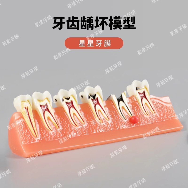 Dental caries model M4011: The development of caries and secondary caries medical teaching model in dentistry Item Picture