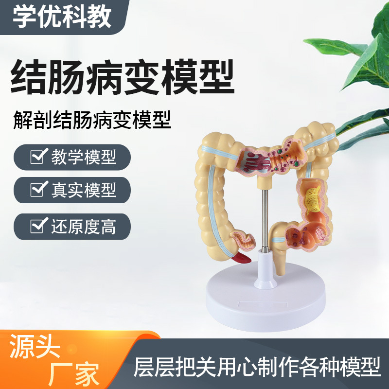 Wholesale of human colon lesion model props for school medical college teaching with high detail reproduction