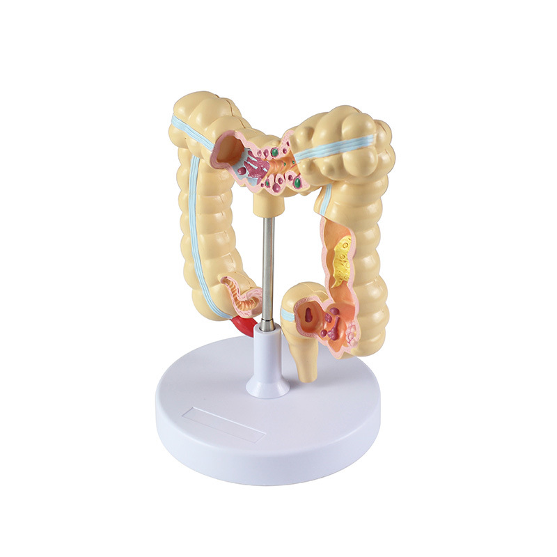 Wholesale of human colon lesion model props for school medical college teaching with high detail reproduction Application Scenario