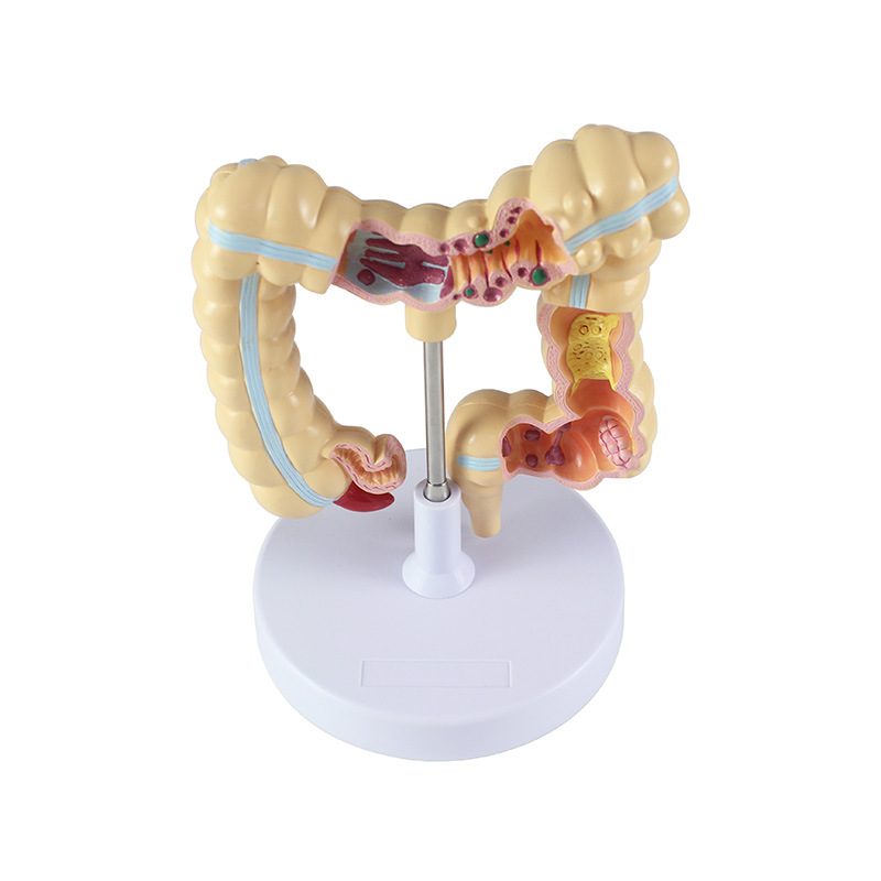 Wholesale of human colon lesion model props for school medical college teaching with high detail reproduction Specification image