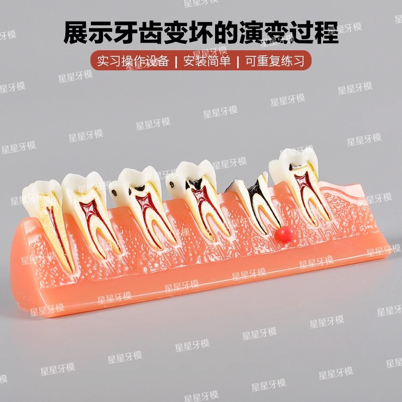 Dental caries model M4011: The development of caries and secondary caries medical teaching model in dentistry details Picture