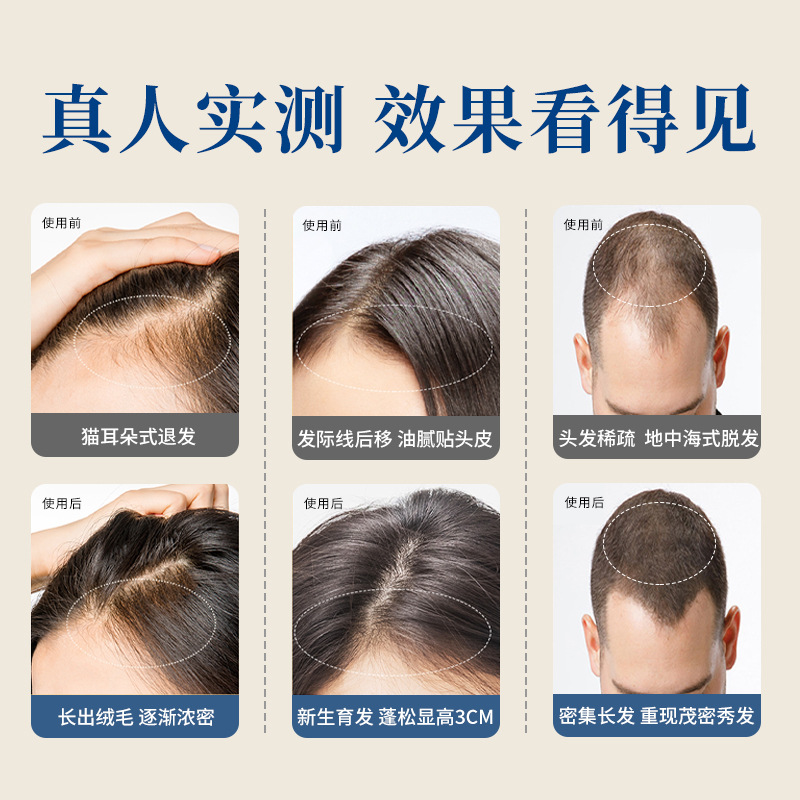 Natural anti-stripping liquid hair growth agent growth dense hair hairline growth liquid hair increase speed natural Application Scenario