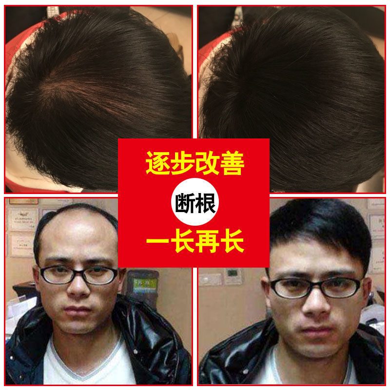 Balicao family breeding hair solution alopecia hair growth ginseng hair growth hormone increase hair dense ginger anti-shedding hair growth agent Specification drawing