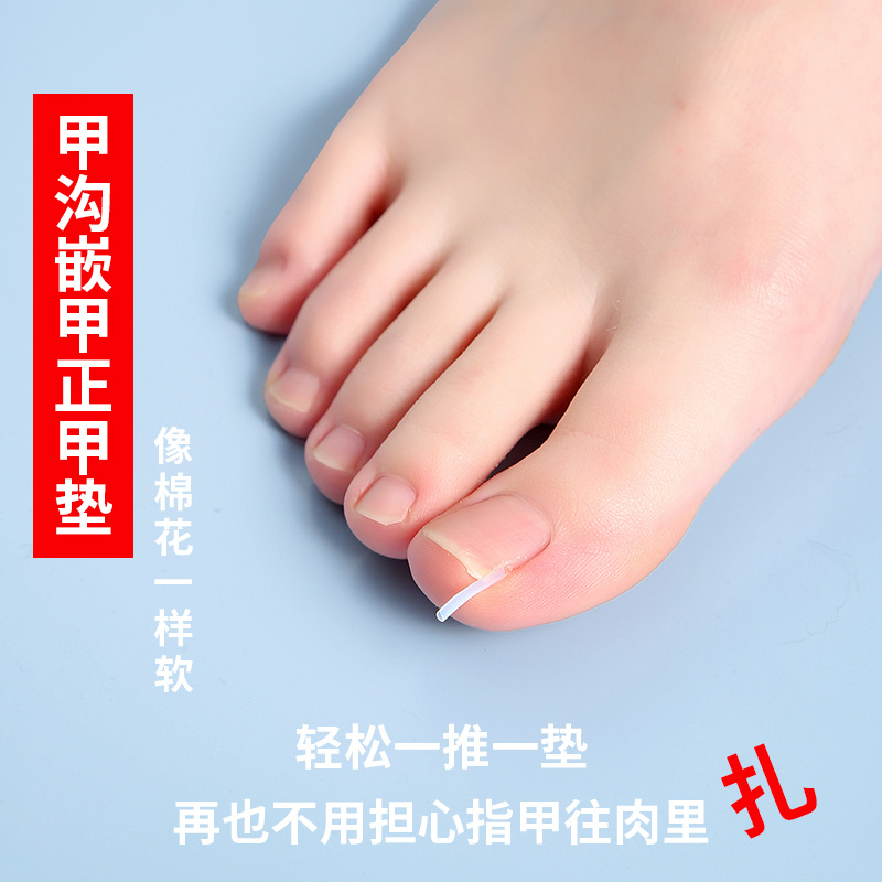 Nail groove corrector, a must-have tool for inflammation, nail straightening patch, nail patch, ingrown toenail, toenail growing into the flesh correction, filling and gasket details Picture
