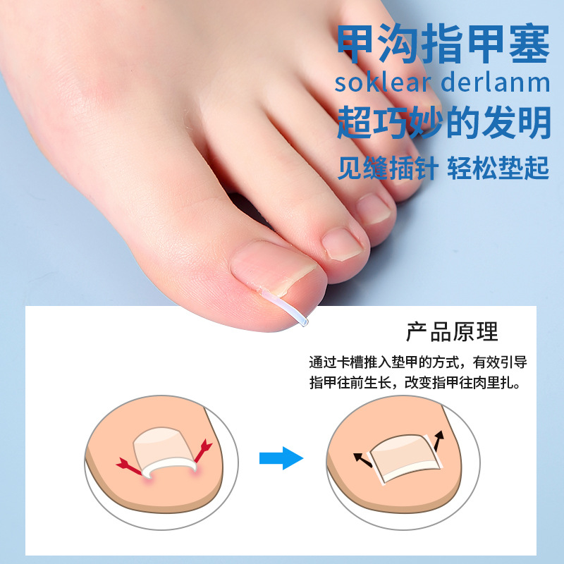 Nail groove corrector, a must-have tool for inflammation, nail straightening patch, nail patch, ingrown toenail, toenail growing into the flesh correction, filling and gasket Specification image
