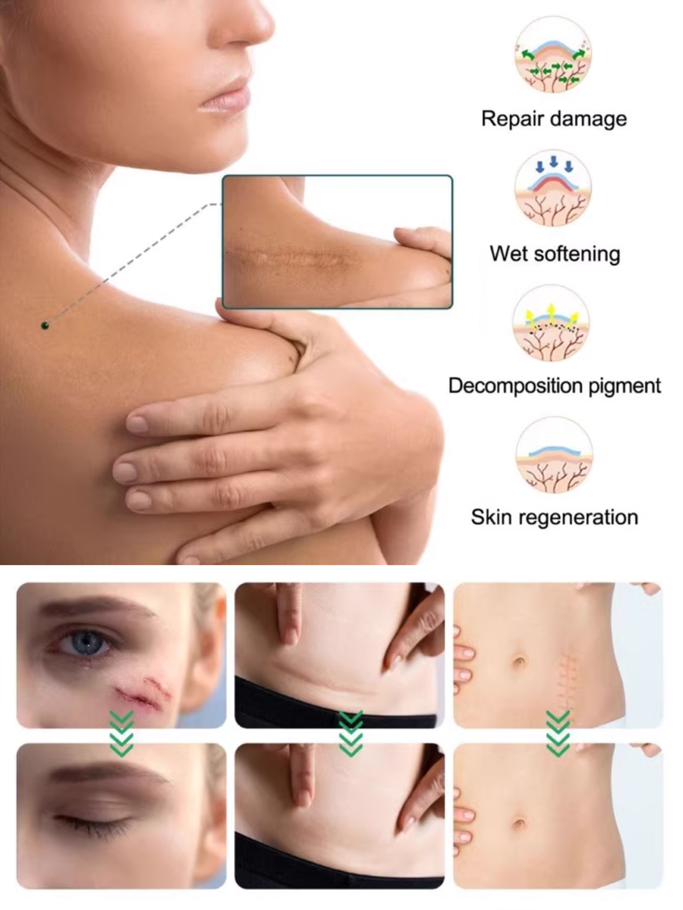 Skin-colored waterproof and breathable silicone gel scar removal tape for repairing stretch marks and cesarean section surgical scars pic 2