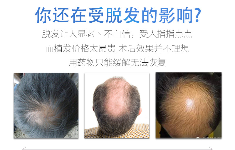 男士补发片假发套头顶补发前额秃顶补发垫接发翻盖假发真发男发块详情5