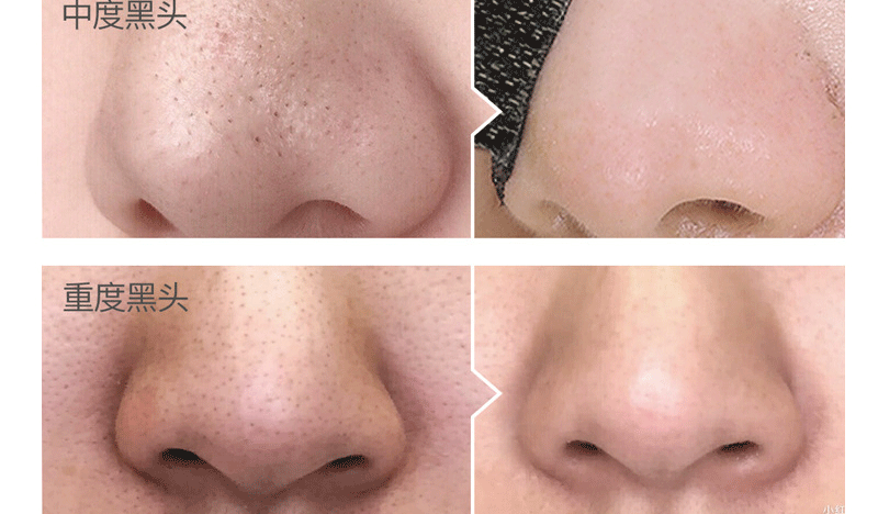 Dear She Avocado Mask, peel-off head Mask/Nose mask, clean pores, absorb oil, cross-border export pic 13