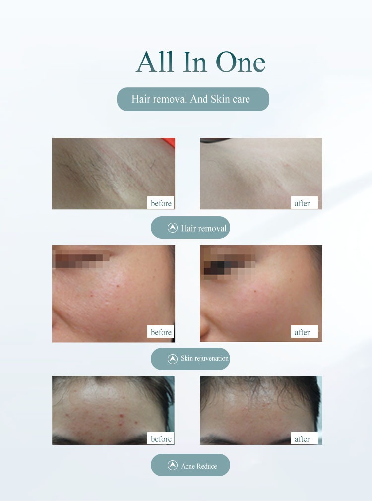 跨境热销脱毛仪手持激光脱毛仪家用女士无痛脱毛去腋毛全身脱毛器详情12