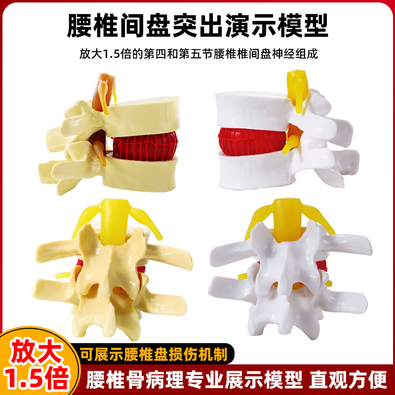 Genuine medical intervertebral disc model, human lumbar protrusion, spinal bone pathology demonstration, standard joint model