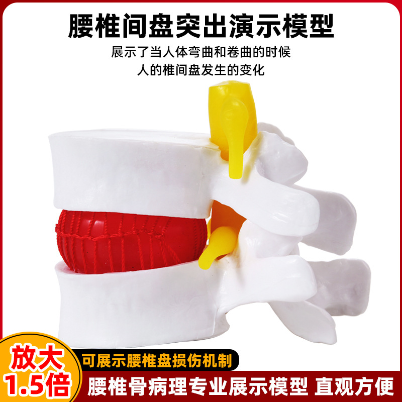 Genuine medical intervertebral disc model, human lumbar protrusion, spinal bone pathology demonstration, standard joint model details Picture