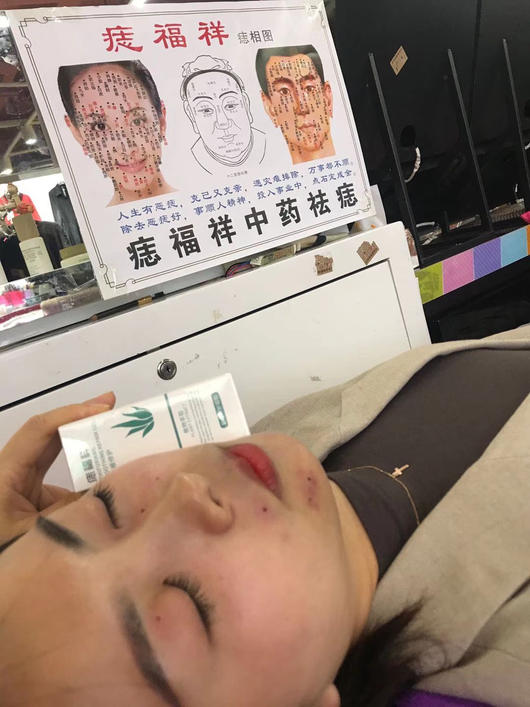 痣福祥中药祛痣详情图1