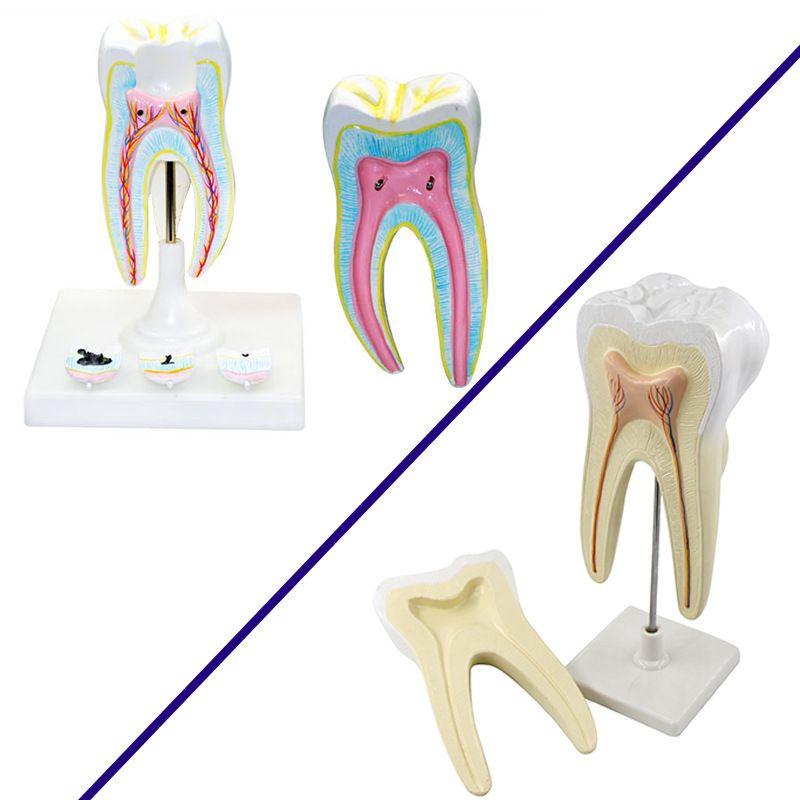 青华臼齿带蛀牙模型 人体牙齿解剖教学生物医学演示详情图1