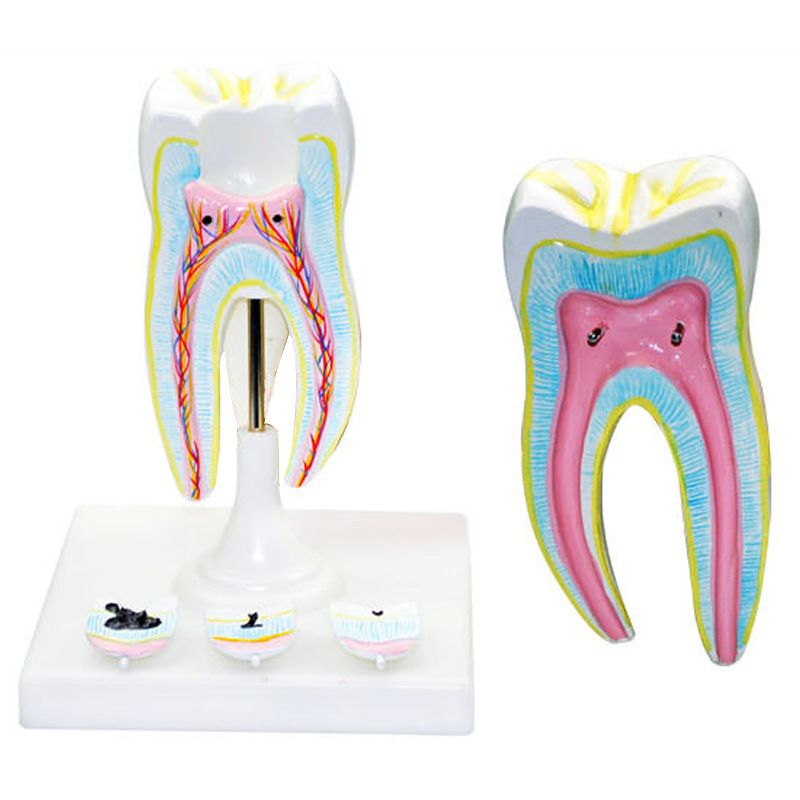 青华臼齿带蛀牙模型 人体牙齿解剖教学生物医学演示详情图2