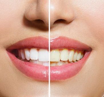 牙齿美白笔实物图