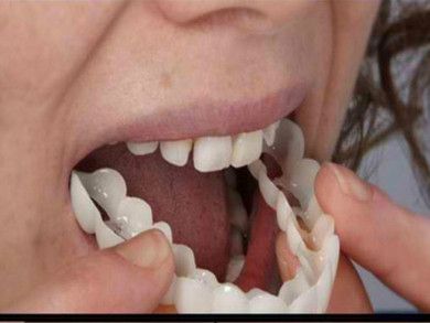 أطقم أسنان مزيفة من طراز SNAP Sille details Picture