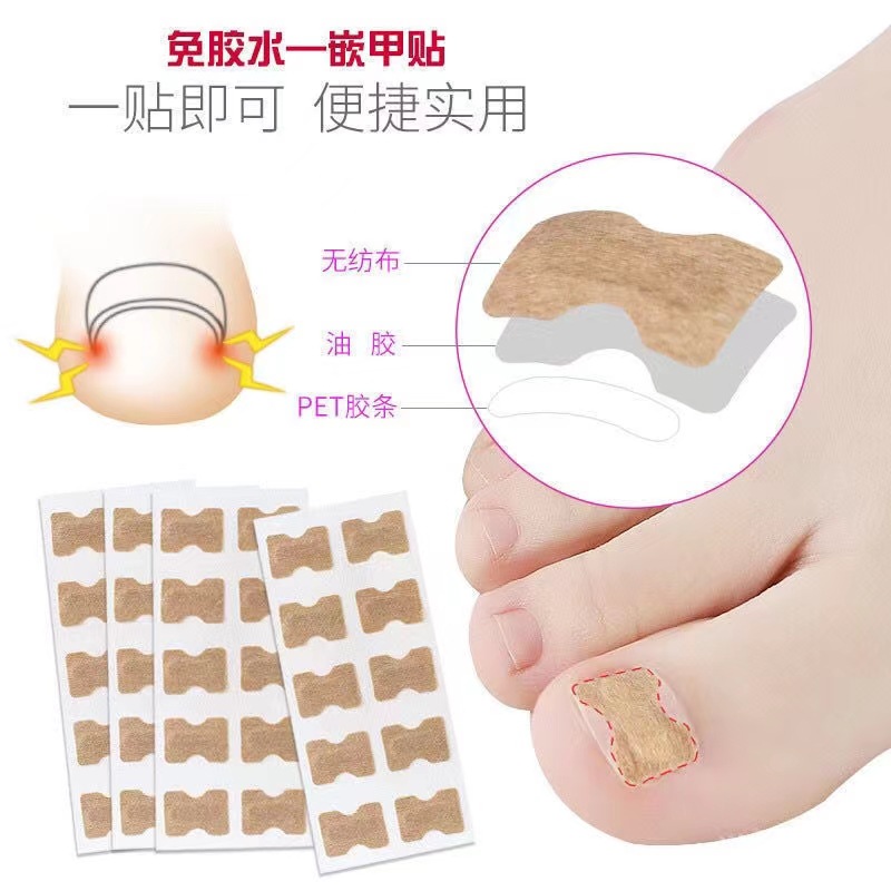 免胶水正甲贴脚趾甲甲沟嵌甲炎矫正器脚趾甲贴片拉修指甲