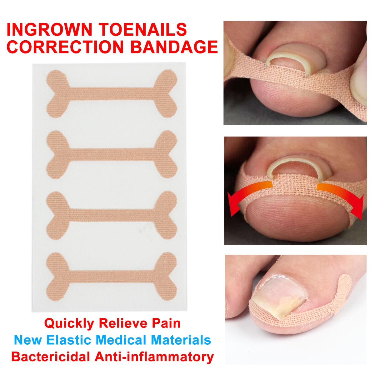 Nail Bandage Tape Quily Relieve Nail Groove Pain Toenail Straightening Stier Ingrown Nail Micro-Force Brace Nail Groove Pain