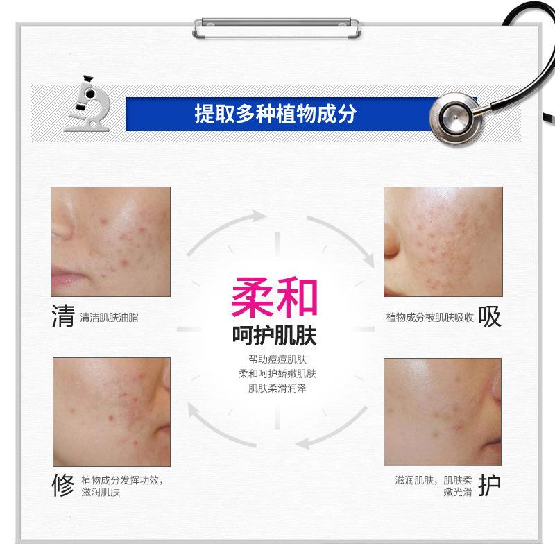 Bioaqua Shurun Clear Face Anti-Acne Cream Anti-Acne Mild Hydrating Nourishing Moisturizing Cleansing Anti-Acne Cream Direct Sales Application Scenario