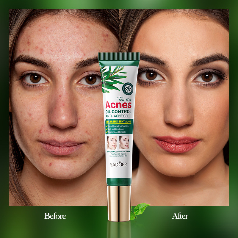 All-english SADOER tea Tree Acne and Oil Control Gel, Gentle Moisturizing Student Acne Mark Gel, cross-border export wholesale Item Picture
