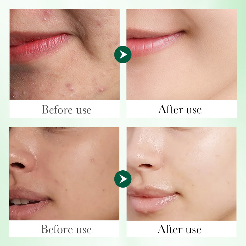 SADOER Salicylic acid Acne Essence, Student Acne Essence, cross-border export wholesale Item Picture