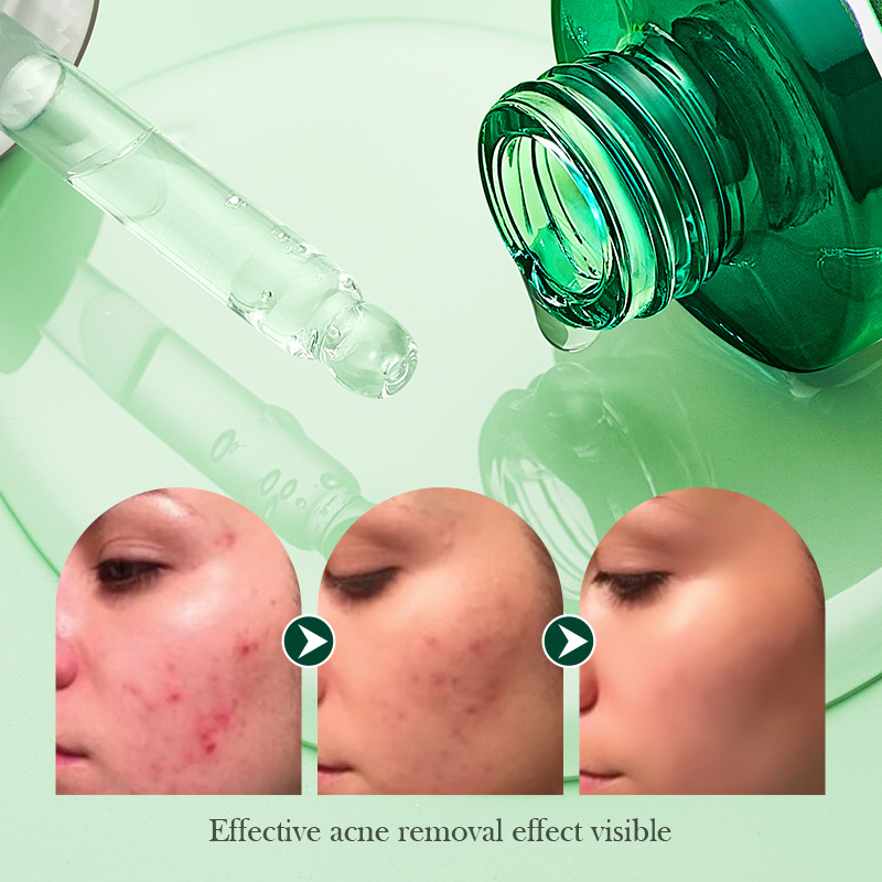All-english SADOER Tea Tree Acne and Oil Control Essence, Student Hydrating and Anti-acne Original Liquid, cross-border export wholesale Item Picture