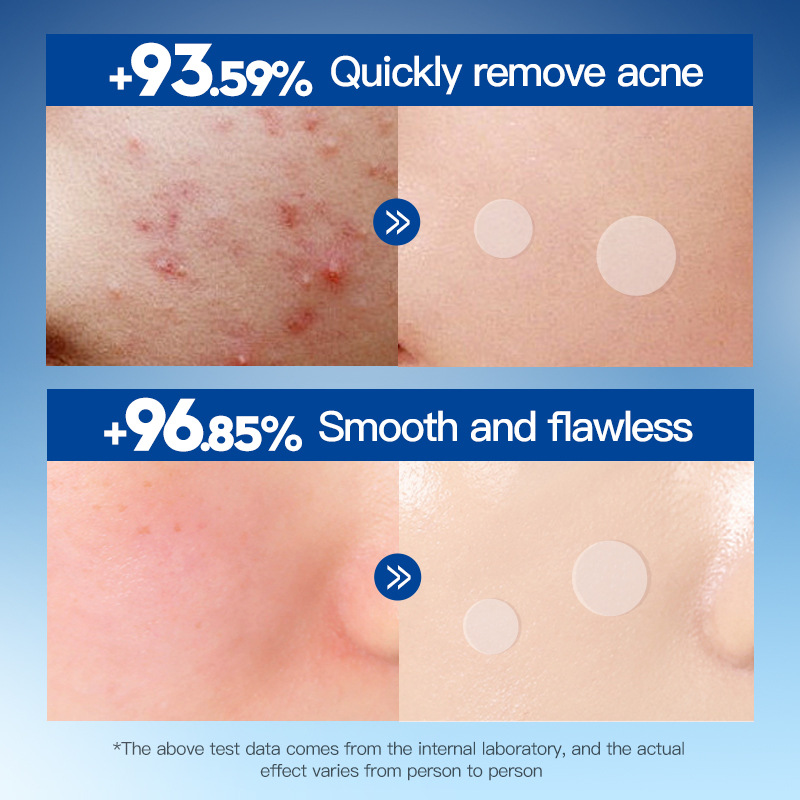 All-english SADOER men's hydrocolloid acne Patches, student acne removal and hydration acne patches, cross-border export wholesale Application Scenario