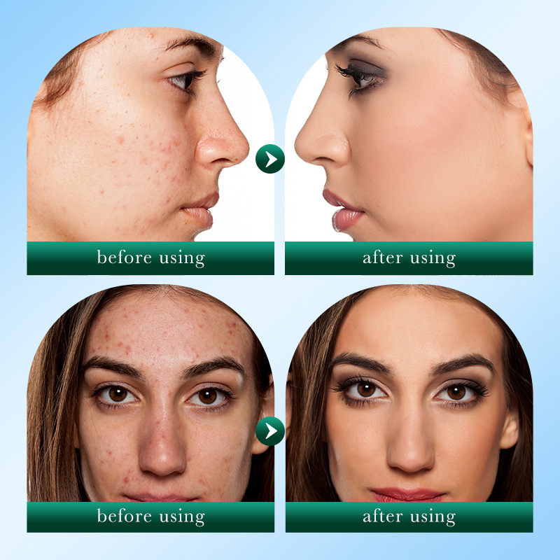 SADOER Tea Tree Acne and Oil Control Facial Cleanser, gentle cleansing and acne removal student Facial Cleanser, cross-border wholesale Application Scenario