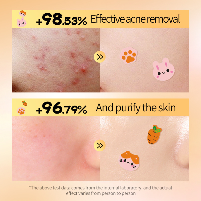 All-english SADOER rabbit and cat acne Patches, student acne removal and Hydration Acne patches, cross-border export wholesale Application Scenario